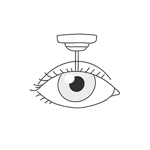 Refraktive Chirurgie Illustration